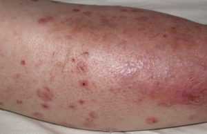 Диабетическая дермопатия