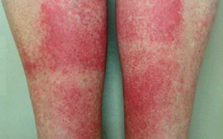 Профилактика и рекомендации