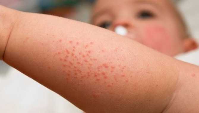 симптомы диабета у детей