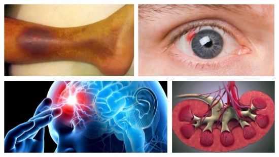 Осложнения сахарного диабета