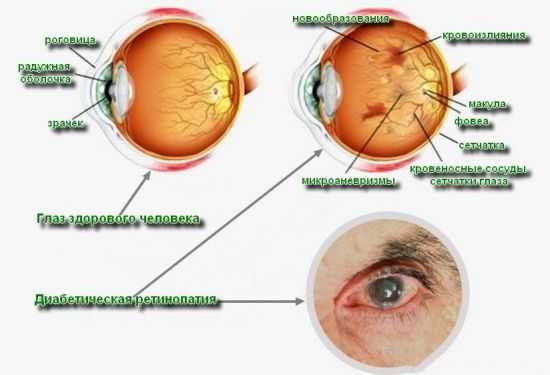Диабетическая ретинопатия