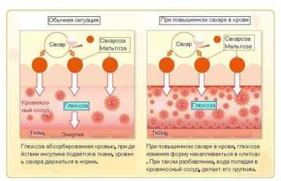 Сахарный диабет - как он проявляется при различных типах