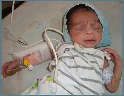 Диабет у новорожденных и грудничков