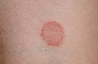 Диабетическая дерматопатия