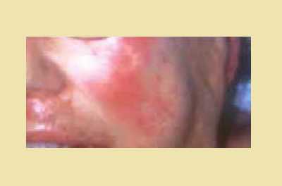 Диабетическая эритема