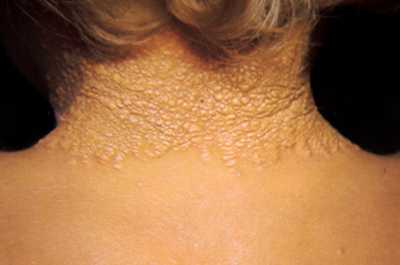 Диабетическая ксантома