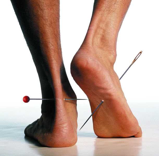 Диабетическая нейропатия ног