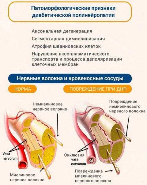 диабетическая полинейропатия симптомы