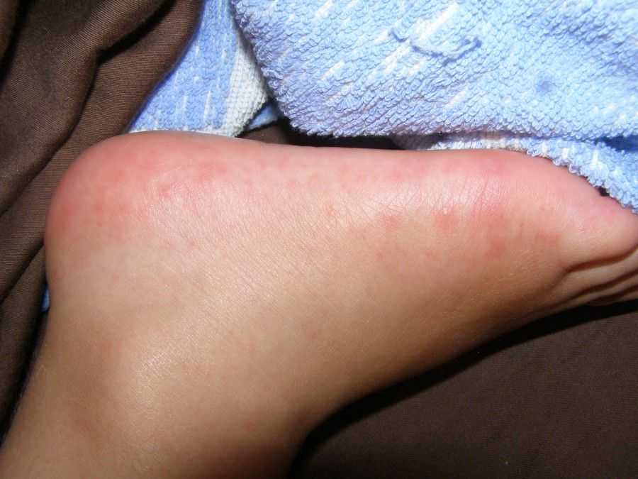 Трофические язвы