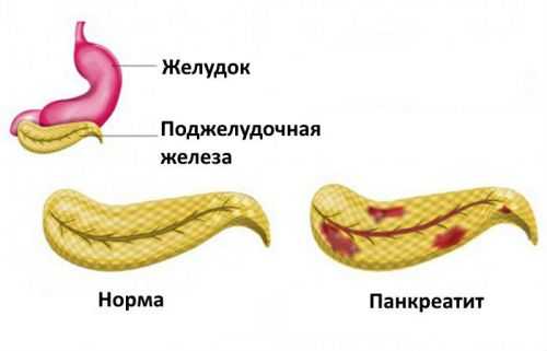 Панкреатит