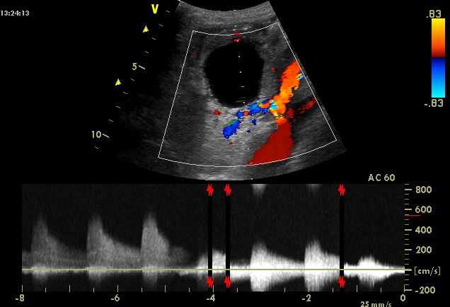 Доплерография