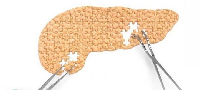 Можно ли умереть от панкреатита и как этого избежать