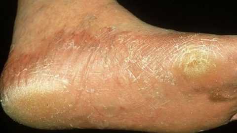 Эпидермофития стоп