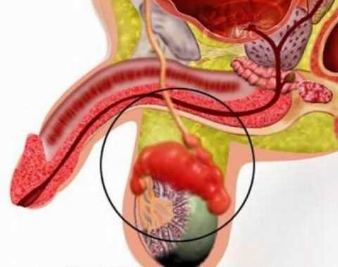 Эпидидимит связан с деятельностью патогенных бактерий Эпидидимит связан с деятельностью патогенных бактерий