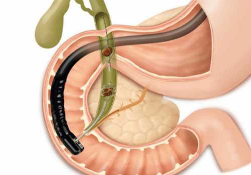 холангиопанкреатография