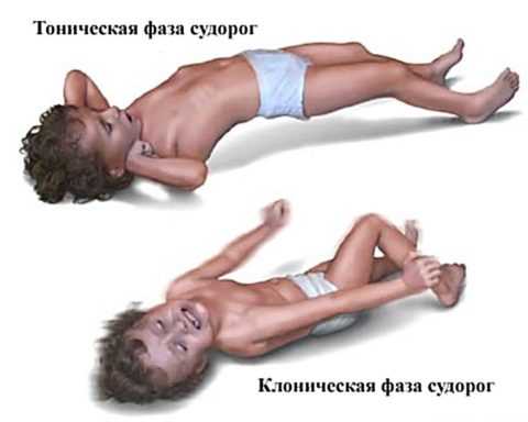 Фазы эпилептических судорог Фазы эпилептических судорог