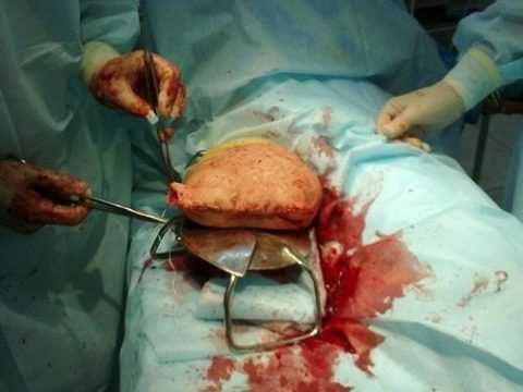 Формирование культи Формирование культи