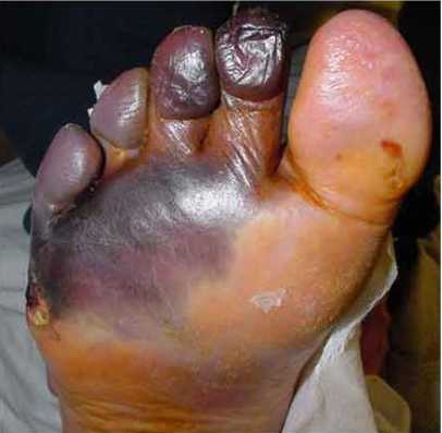 Гангрена при сахарном диабете Гангрена при сахарном диабете