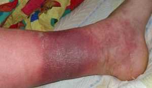 Гангрена нижних конечностей при сахарном диабете