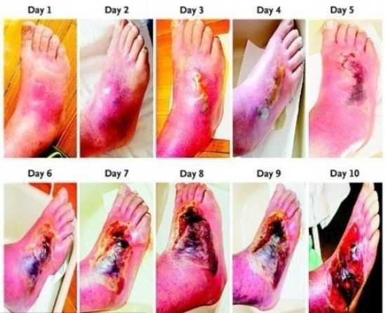 Влажная гангрена