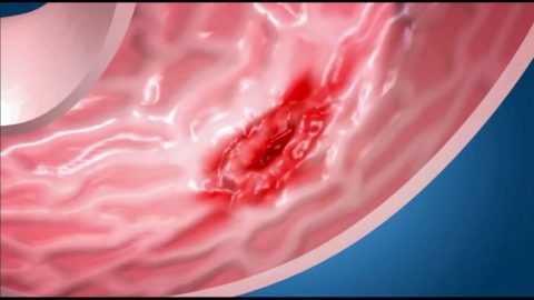 Гастрит может стать причиной язвы желудка. Гастрит может стать причиной язвы желудка.