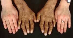 Гемохроматоз - бронзовый диабет