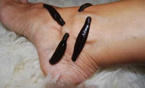 Гирудотерапия при диабетической стопе Гирудотерапия при диабетической стопе