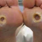 Глубокие язвы на третьей стадии