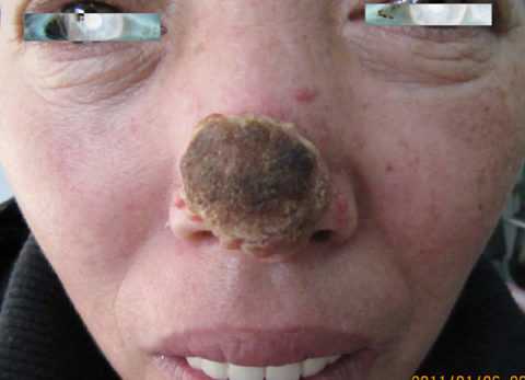 Глубокий мукороз носа