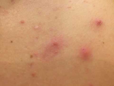 Гнойная сыпь на разных участках кожи.