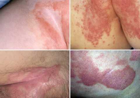 Грибковое поражение кожи