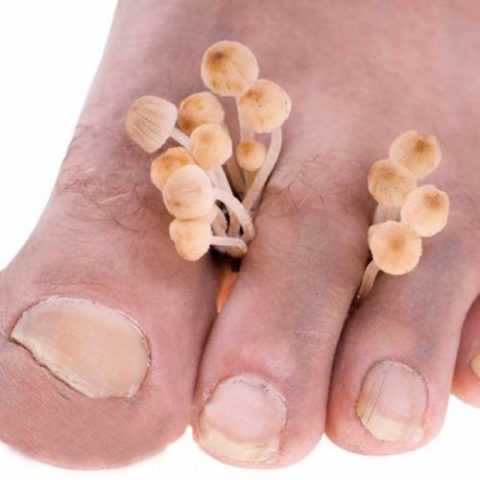 Грибковые поражения. Грибковые поражения.