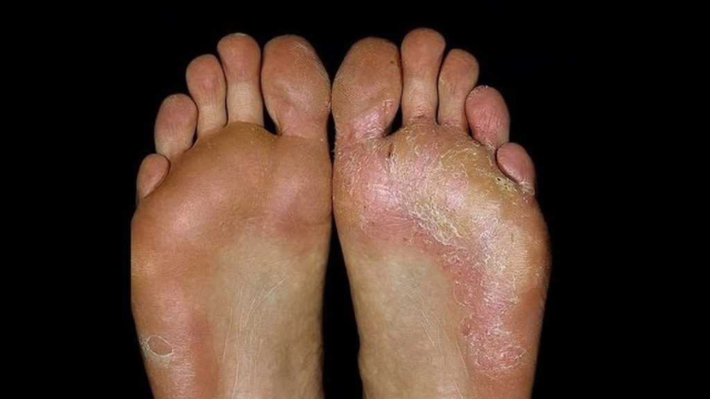 Осложнения