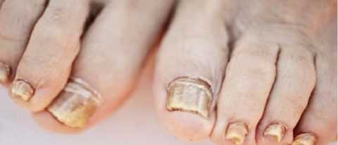 Характерные для грибкового поражения признаки.