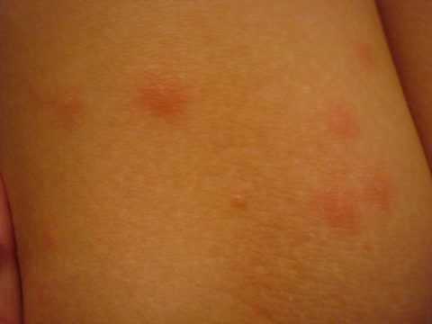 Характерные высыпания. Характерные высыпания.