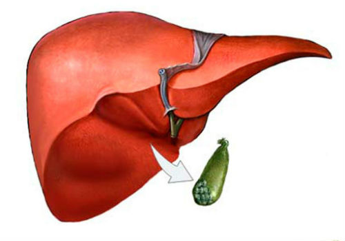 Развитие желчекаменной болезни