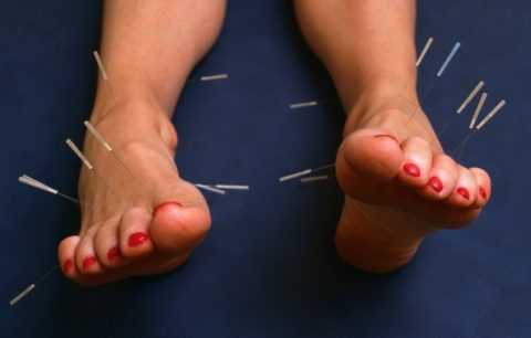 Иглоукалывание при развитии синдрома диабетической стопы Иглоукалывание при развитии синдрома диабетической стопы