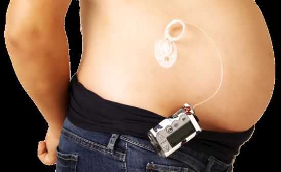 Инсулиновая помпа при беременности