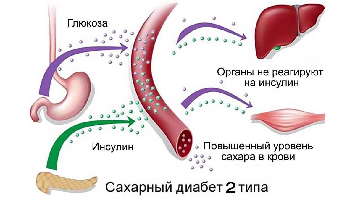 Механизм развития СД