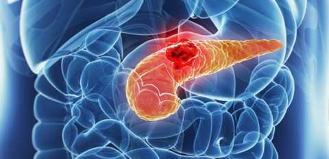 Инсулинома – довольно редкое, но весьма опасное заболевание.