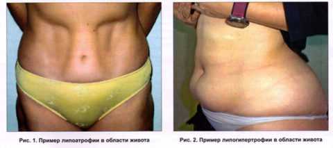 Инсулиновая липодистрофия Инсулиновая липодистрофия