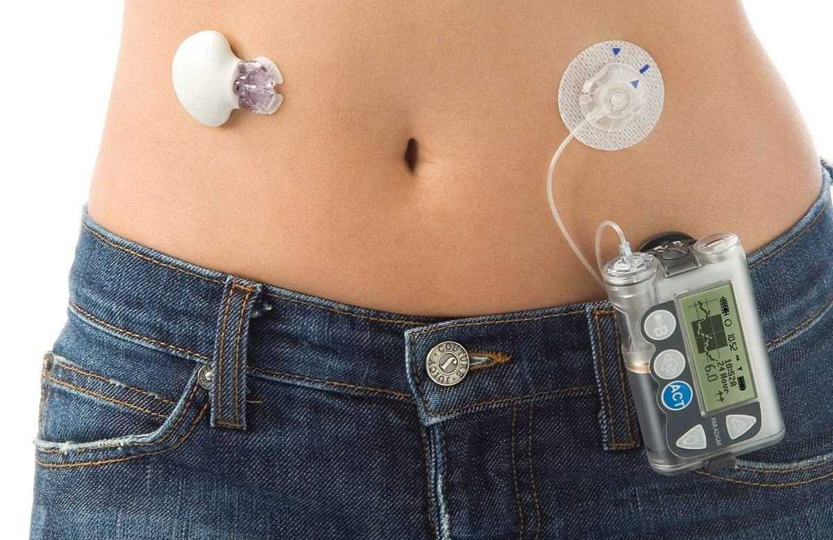 инсулиновая помпа Акку чек на теле