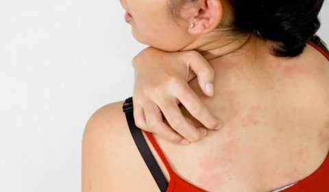 Интенсивный зуд.