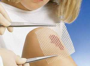 Использование стерильной марли Использование стерильной марли