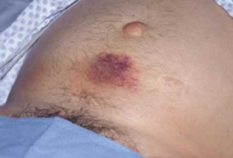 Изменение кожного покрова.