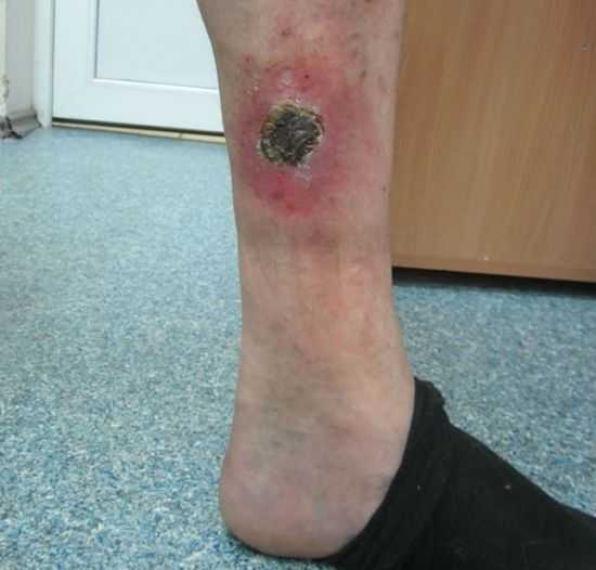 Трофическая язва