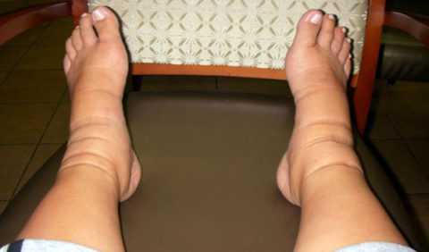 Как проявляется отек.