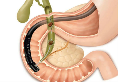 камни в панкреатическом протоке