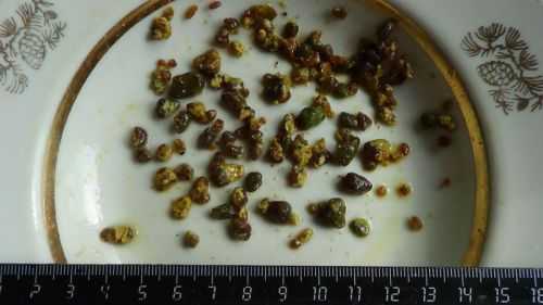 Камни поджелудочной железы