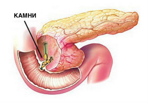 камни в протоках